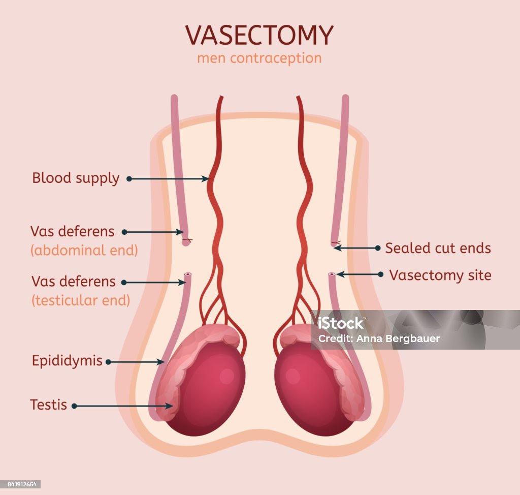 Affordable Vasectomy Options Across New Zealand