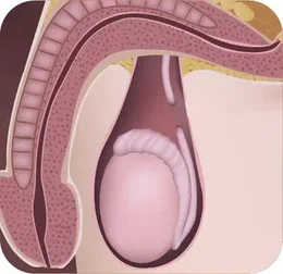 Vasectomy Auckland Cost Breakdown: How Much Should You Budget?